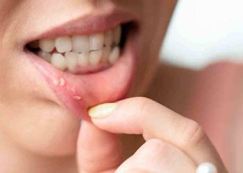 Aft nedir, neden olur? Aft yarasını geçiren gargara I Sumak afta iyi geliyor mu