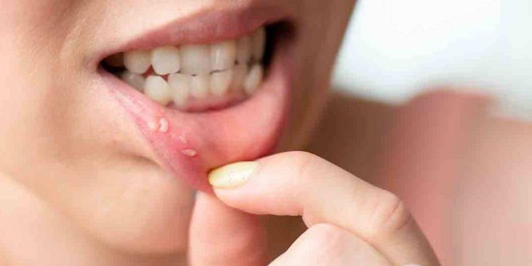 Aft nedir, neden olur? Aft yarasını geçiren gargara I Sumak afta iyi geliyor mu